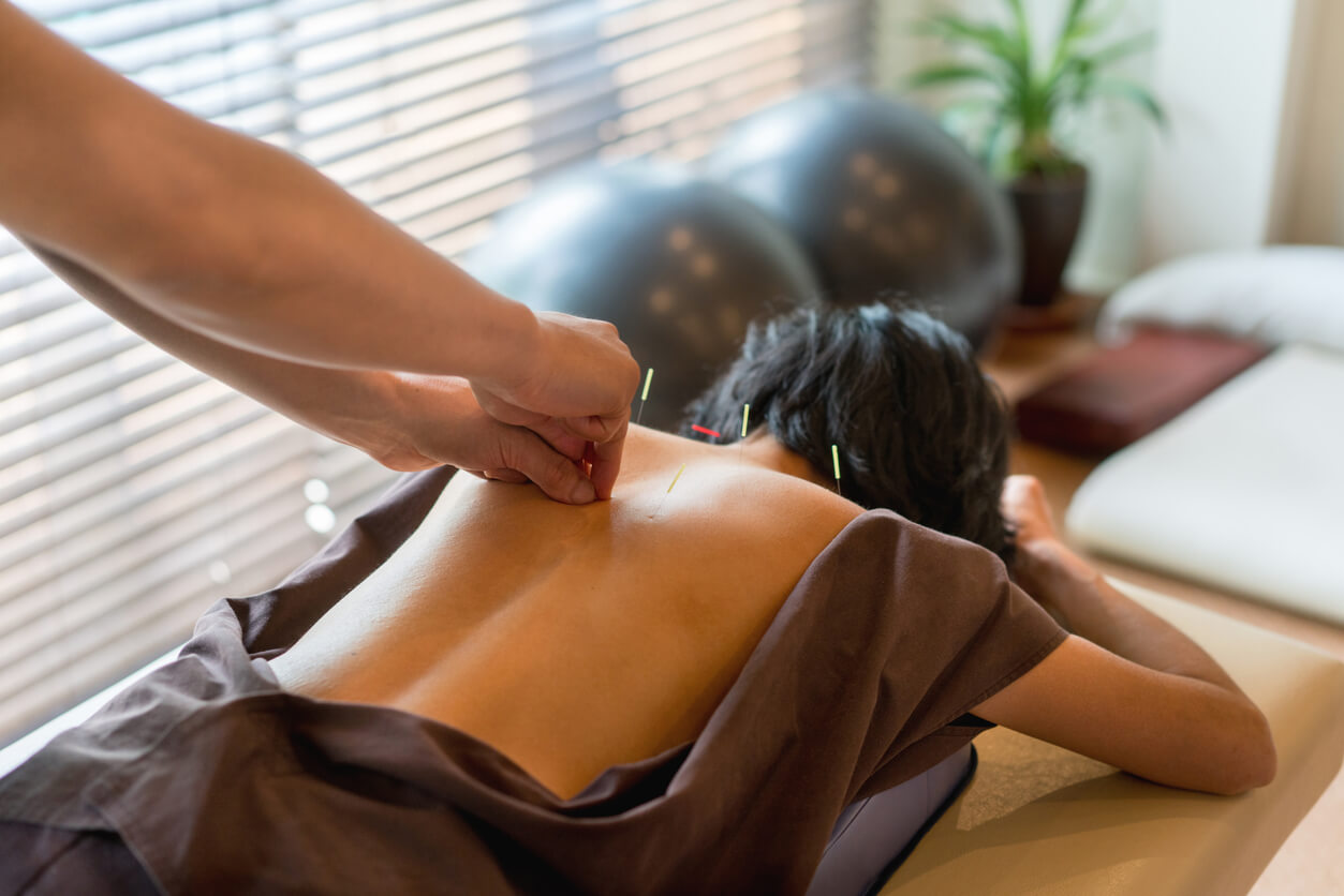 Person receiving acupuncture treatment with needles inserted in the back, in a serene clinic environment, emphasizing holistic healing and wellness.