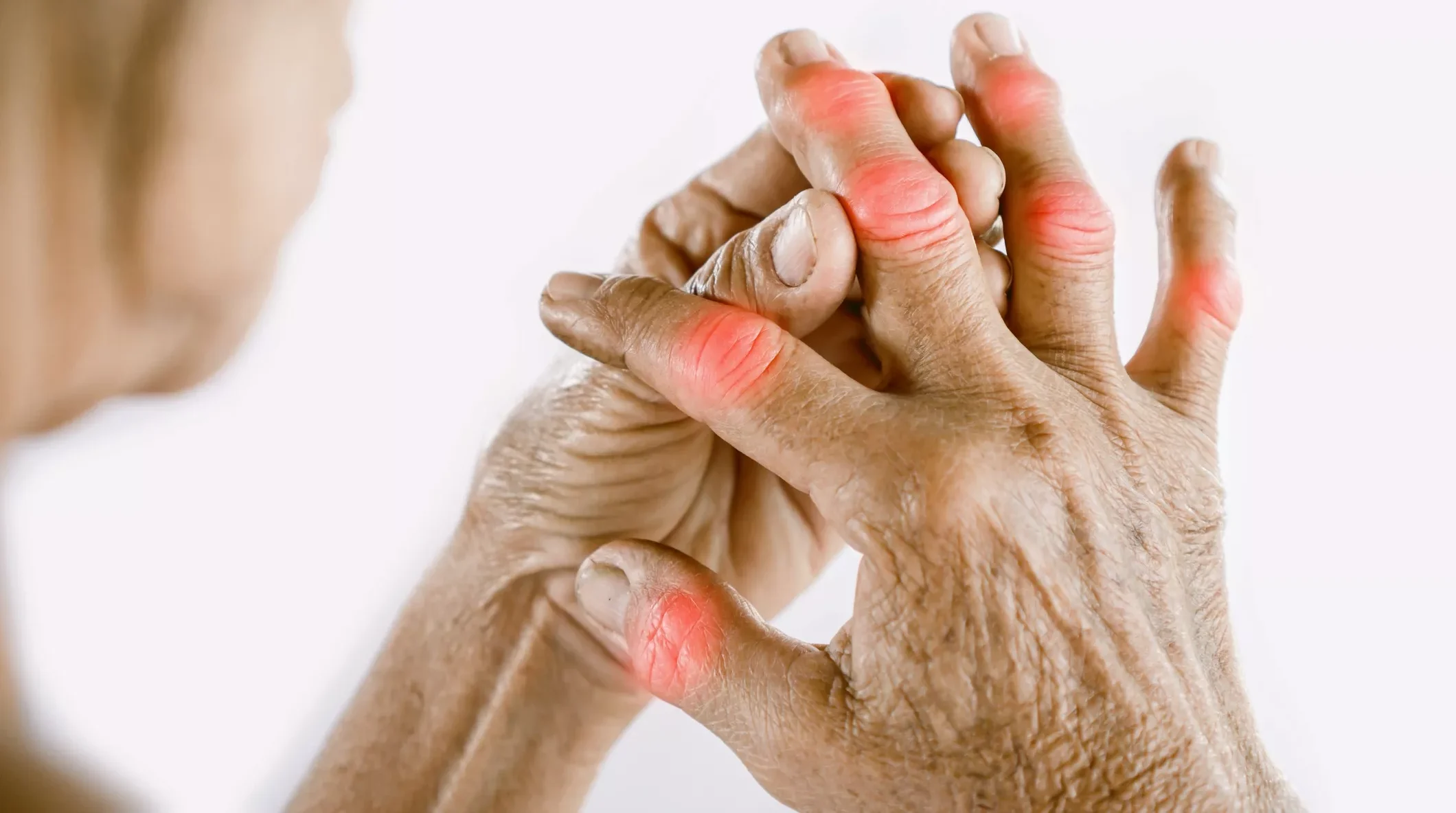 Hands showing signs of arthritis with red inflammation around the joints, highlighting joint pain and discomfort related to arthritis conditions.