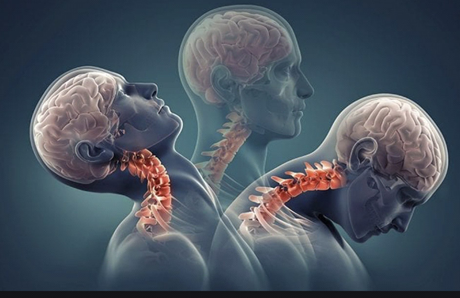 Illustration of three human figures showing neck and spinal alignment, highlighting whiplash injury effects related to auto accidents, relevant to chiropractic care and treatment options for whiplash injuries.